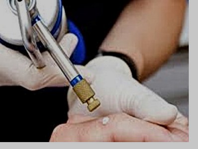 Erkeklerde Genital Siğil Tedavisi